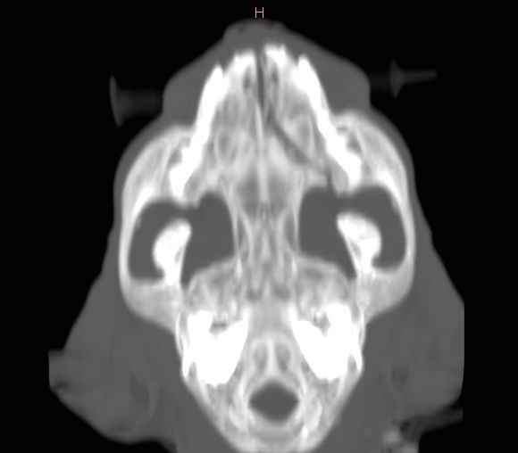 3D reconstruction CT scan demonstrating maxillary fracture